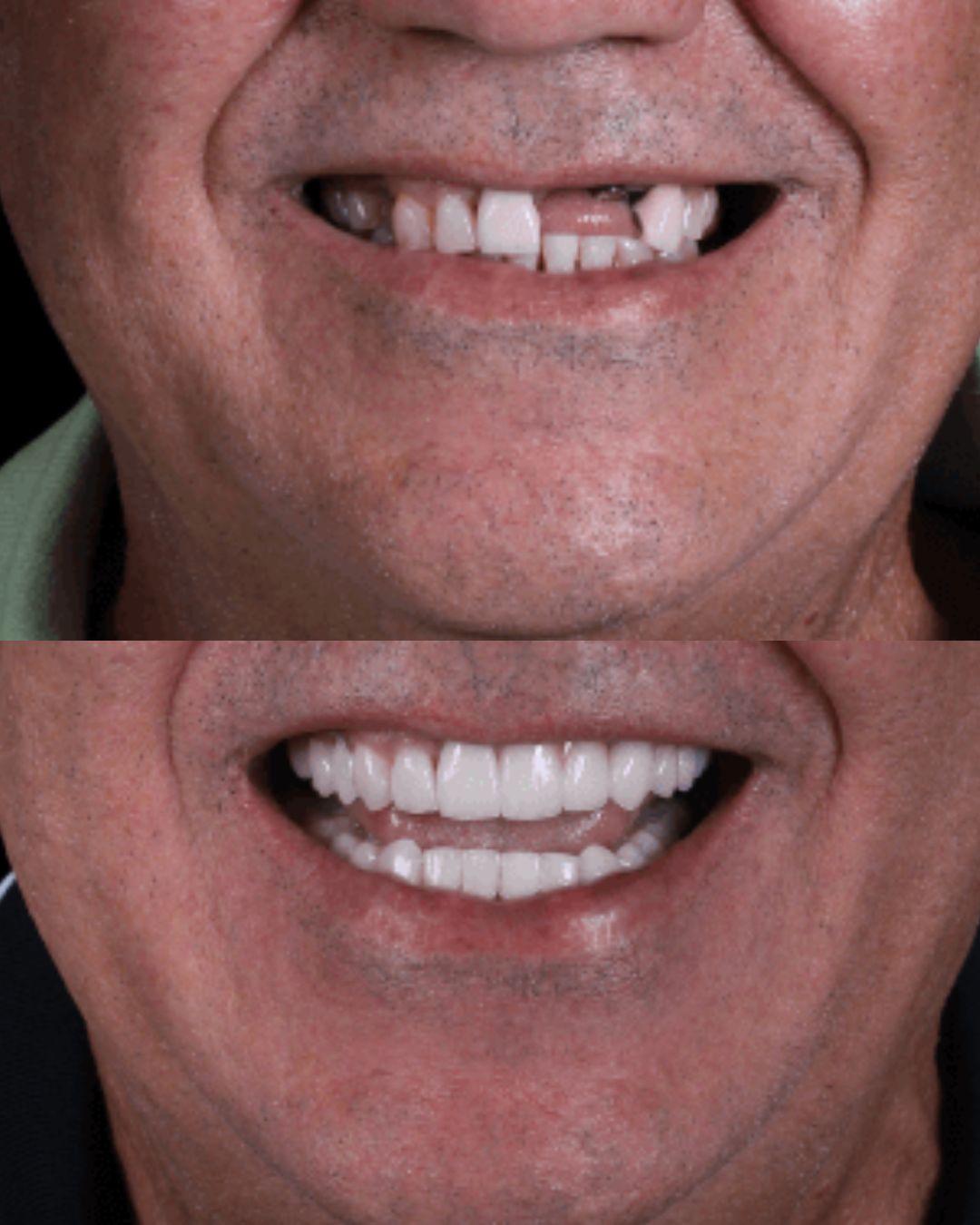 Antes e depois — reabilitação oral com implantes